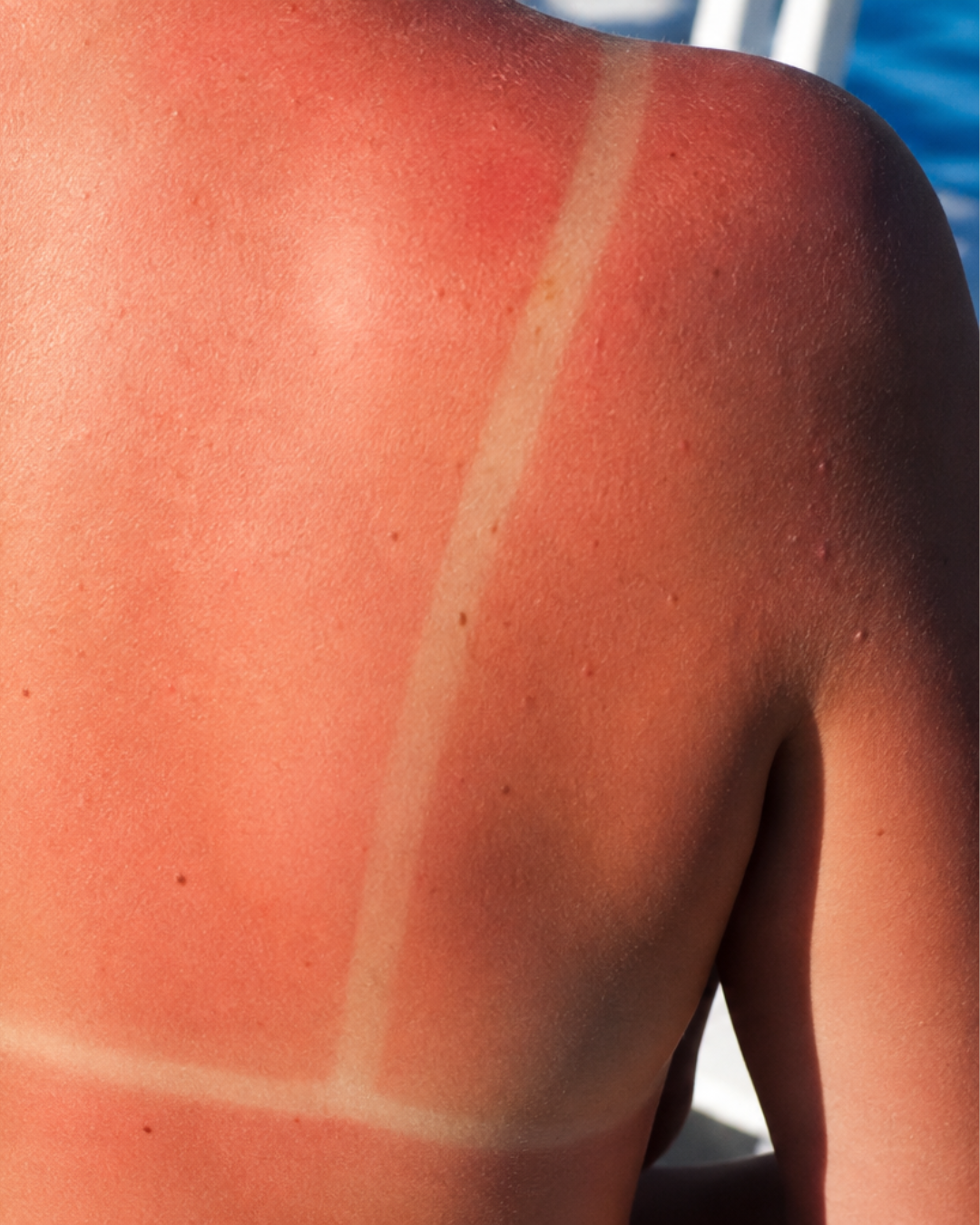 Scottature solari: come prevenirle e cosa fare